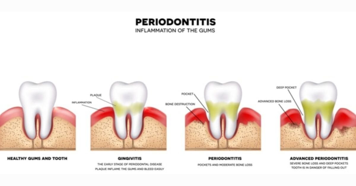 what is a periodontist